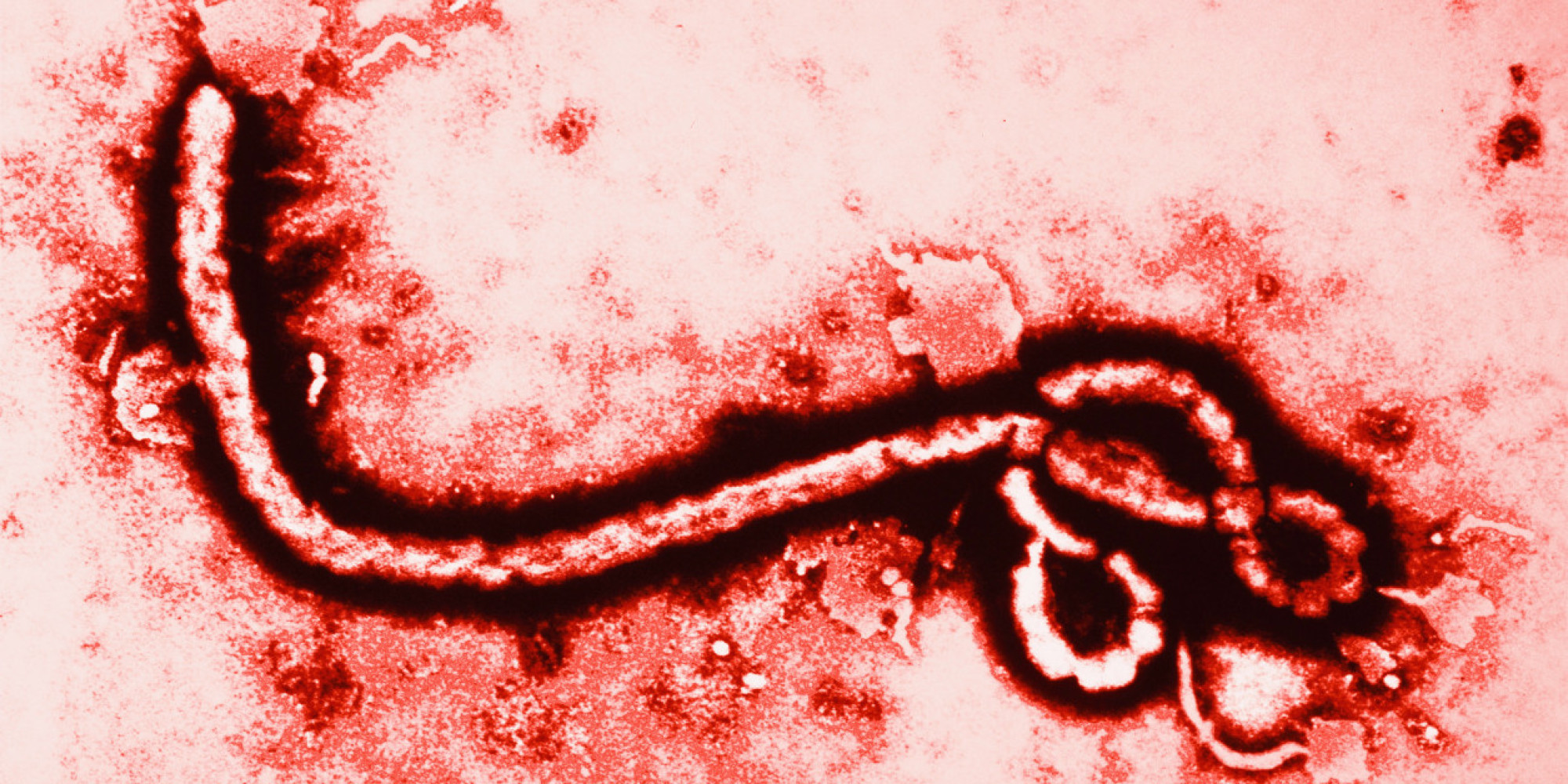 Recognizing Ebola Symptoms Is Crucial